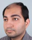 Before Hair Transplant&nbsp;Front